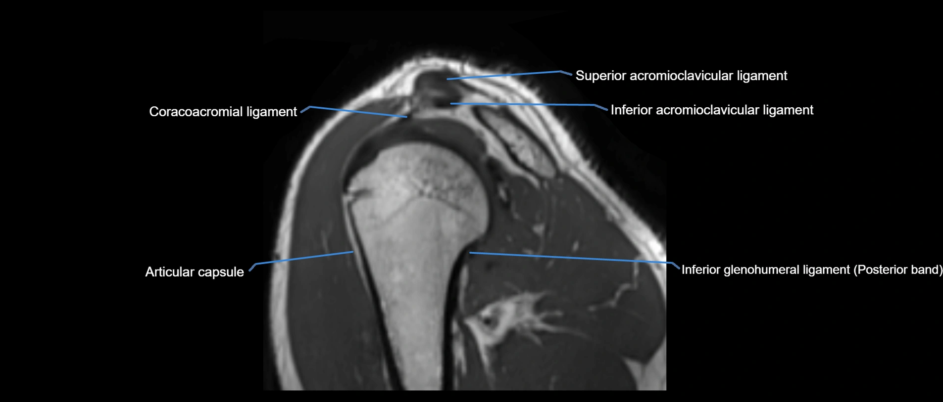 shoulder ligaments sagittal  cross sectional anatomy 3T MRI AI enhanced radiology image -img-00001-00042.webp